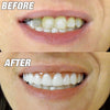 Instant Smile Comfort Fit Flex Top Teeth As Seen On TV Hot 10
